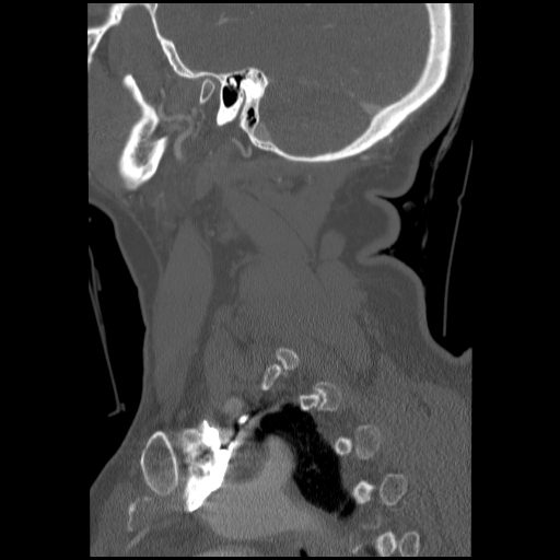 File:C1 anterior arch (plough) fracture - type 1 (Radiopaedia 76181-87720 Sagittal bone window 27).jpg