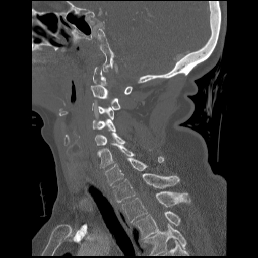 File:C1 anterior arch (plough) fracture - type 1 (Radiopaedia 76181-87720 Sagittal bone window 51).jpg
