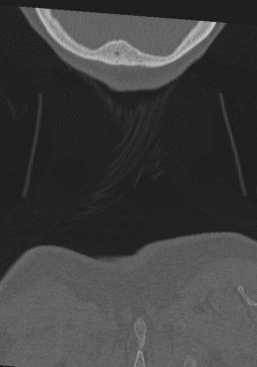 C2 fracture with vertebral artery dissection (Radiopaedia 37378-39199 Coronal bone window 72).png
