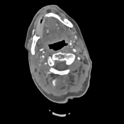 C2 fracture with vertebral artery dissection (Radiopaedia 37378-39200 A 168).png