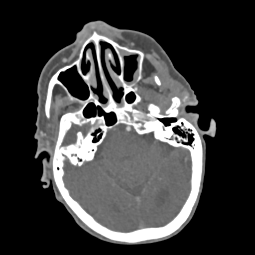 C2 fracture with vertebral artery dissection (Radiopaedia 37378-39200 A 214).png