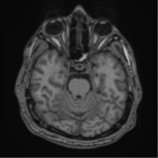 CNS vasculitis (Radiopaedia 55715-62263 Axial T1 1).png