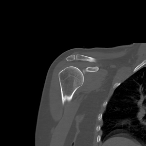 File:Calcific tendinitis of the infraspinatus tendon (Radiopaedia 87256-103539 Coronal bone window 24).jpg