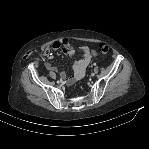 Calcified adrenal glands and Spigelian hernia (Radiopaedia 49741-54988 A 183).jpg