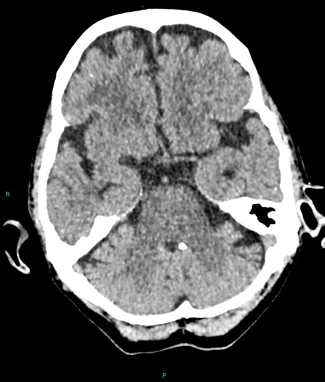Calcified cerebral emboli from left ventricular thrombus (Radiopaedia 84420-99758 Axial non-contrast 66).jpg