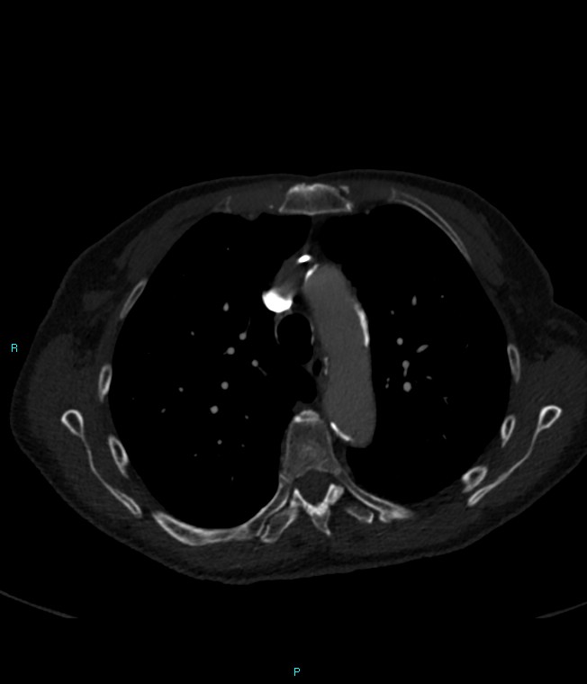 Calcified cerebral emboli from left ventricular thrombus (Radiopaedia 84420-99760 Axial bone window 24).jpg