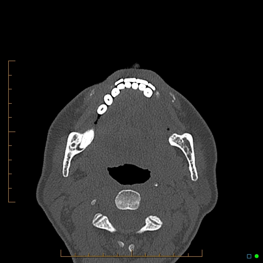 Calcified facial augmentation fillers (Radiopaedia 79514-92679 Axial bone window 119).jpg