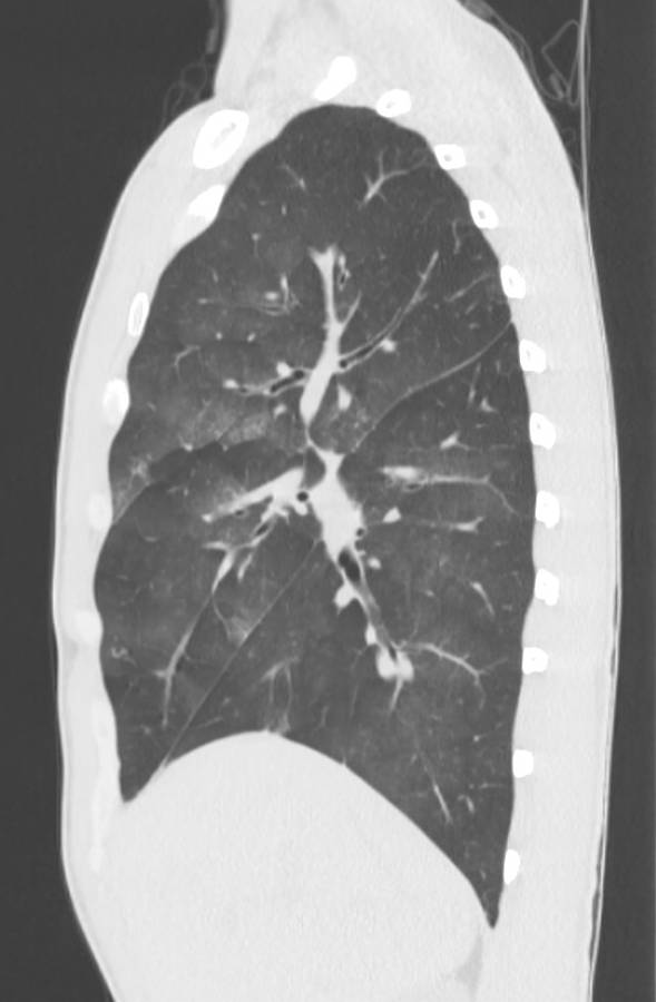 Cannabis-induced diffuse alveolar hemorrhage (Radiopaedia 89834-106946 Sagittal lung window 43).jpg