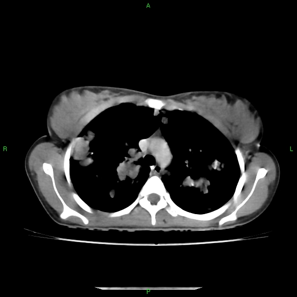 File:Cannon ball metastases - synovial sarcoma (Radiopaedia 26135-26271 C 12).jpg