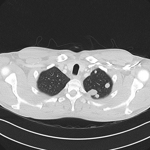 Cannonball metastases - testicular choriocarcinoma (Radiopaedia 84510-99891 Axial lung window 16).jpg