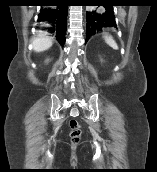 Cannonball metastases from endometrial cancer (Radiopaedia 42003-45031 F 51).png