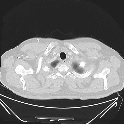 File:Cannonball pulmonary metastases (Radiopaedia 67684-77101 Axial lung window 1).jpg