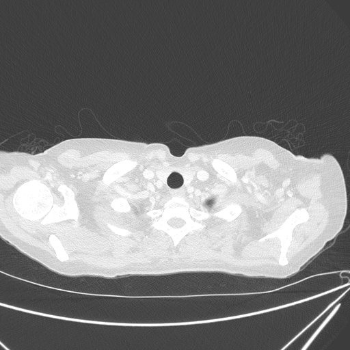 Canonball lung metastasis (Radiopaedia 77634-89837 Axial lung window 13).jpg