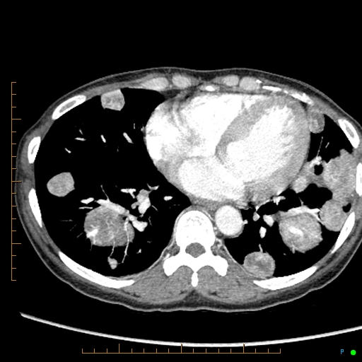 Canonball lung metastasis (Radiopaedia 77634-89837 B 69).jpg