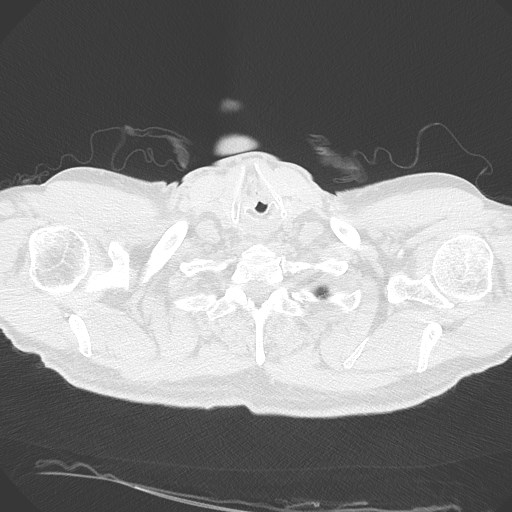 Caplan syndrome (Radiopaedia 56667-63530 Axial lung window 12).jpg