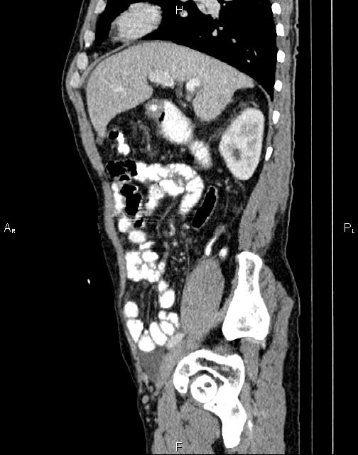 Caput medusae sign - portal hypertension (Radiopaedia 64007-72759 B 22).jpg