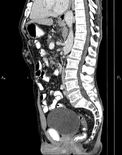Caput medusae sign - portal hypertension (Radiopaedia 64007-72759 B 43).jpg