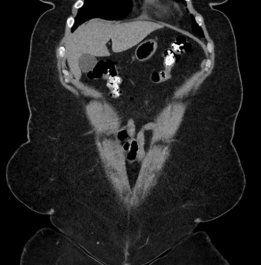 Carcinoid tumor - terminal ileum (Radiopaedia 60931-68740 Coronal non-contrast 16).jpg