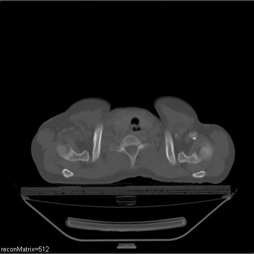 File:Carcinoma of esophagus (Radiopaedia 27356-27550 Axial bone window 32).jpg