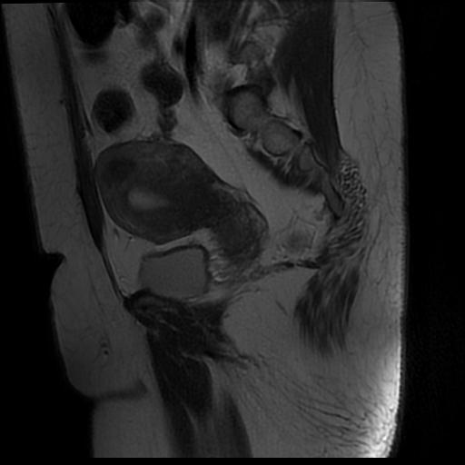 File:Carcinoma of the cervix (Radiopaedia 89018-105858 Sagittal T2 5).jpg
