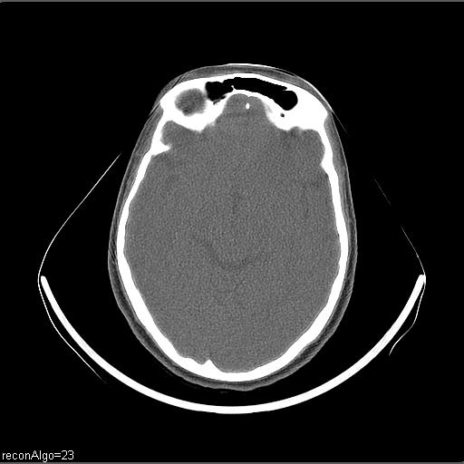 Carcinoma of the maxillary antrum (Radiopaedia 53805-59888 Axial non-contrast 81).jpg