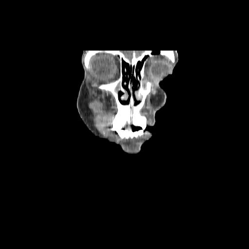 Carcinoma of the maxillary antrum (Radiopaedia 53805-59888 Coronal C+ delayed 16).jpg