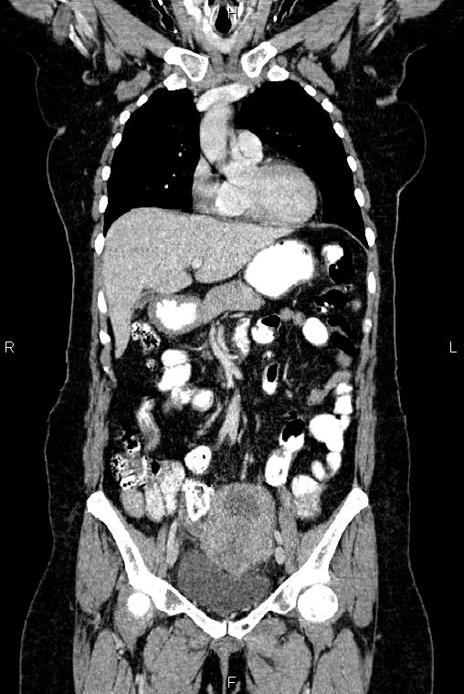 Carcinoma of uterine cervix (Radiopaedia 85861-101700 C 19).jpg