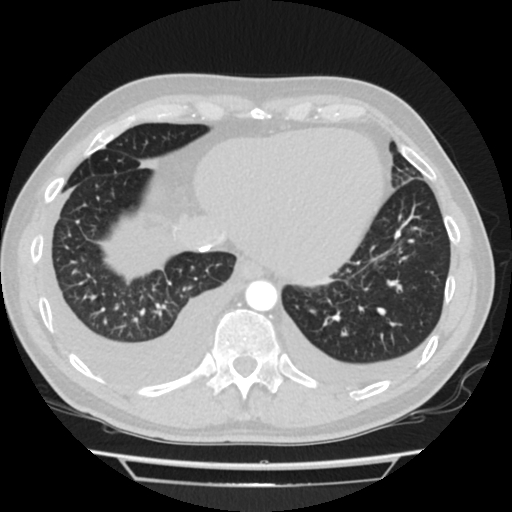 File:Cardiac tamponade (Radiopaedia 78607-91368 Axial lung window 72).jpg