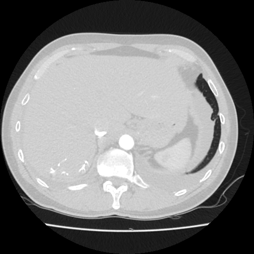Cardiac tamponade (Radiopaedia 78607-91368 Axial lung window 88).jpg