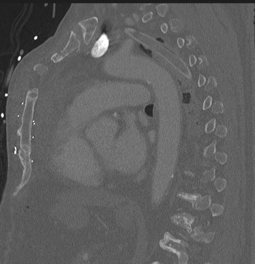 Cardiac trauma (Radiopaedia 32874-33858 Sagittal bone window 22).jpg