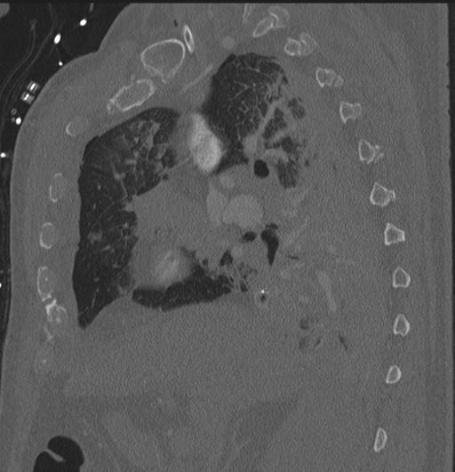 File:Cardiac trauma (Radiopaedia 32874-33858 Sagittal bone window 69).jpg