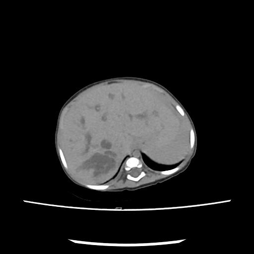 Caroli disease with autosomal recessive polycystic kidney disease (ARPKD) (Radiopaedia 89651-106703 E 38).jpg