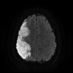 File:Carotid arterial dissection with acute cerebral infarction (Radiopaedia 26636-26784 Axial DWI 16).jpg