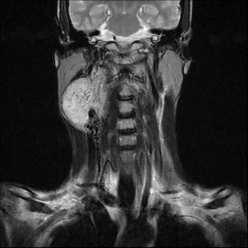 File:Carotid body tumor (Radiopaedia 30208-30823 Coronal T2 11).jpg