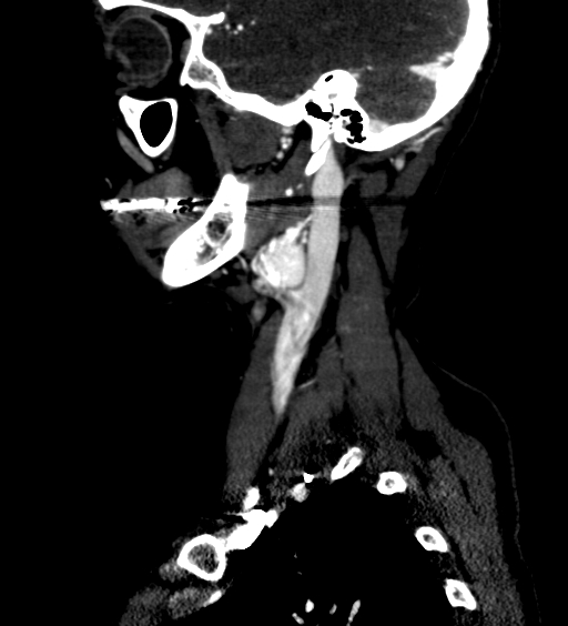 File:Carotid body tumor (Radiopaedia 39845-42300 D 8).jpg