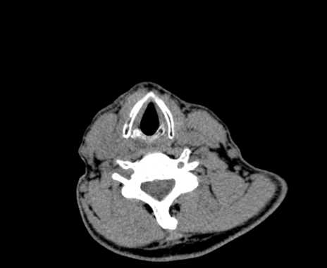File:Carotid body tumor (Radiopaedia 61750-69757 Axial non-contrast 76).jpg