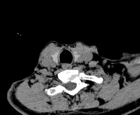 Carotid body tumor (Radiopaedia 61750-69757 Axial non-contrast 96).jpg