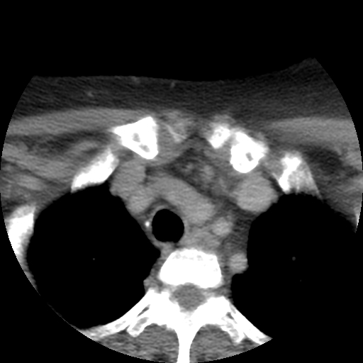 Carotid body tumor (paraganglioma) (Radiopaedia 38586-40729 A 68).jpg