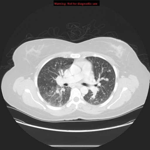 File:Carotid body tumor with lung metastases (Radiopaedia 9301-48390 Axial lung window 33).jpg