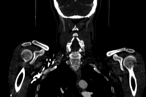 File:Carotid bulb pseudoaneurysm (Radiopaedia 57670-64616 D 68).jpg