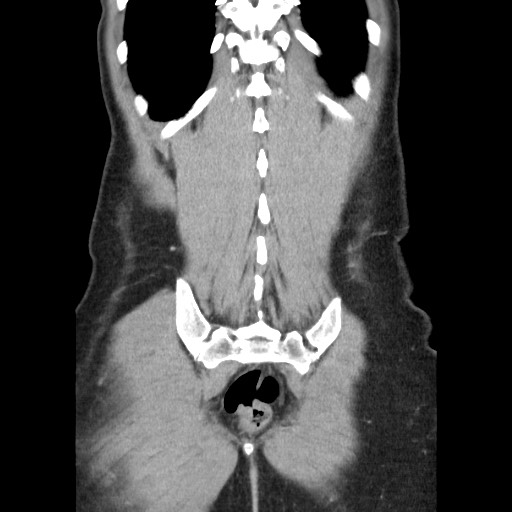 File:Castleman disease with fibrous pseudotumor in the abdomen (Radiopaedia 77296-89373 B 80).jpg