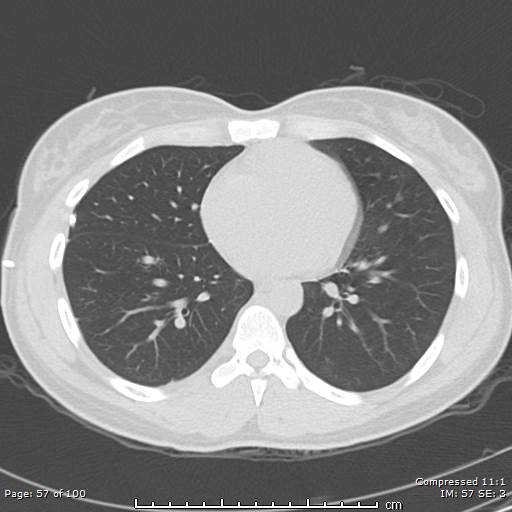 Catamenial pneumothorax (Radiopaedia 54382-60600 Axial non-contrast 57).jpg