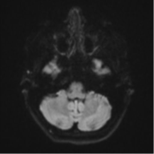 File:Cavernoma with bleed - midbrain (Radiopaedia 54546-60774 Axial DWI 33).png