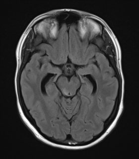 File:Cavernoma with bleed - midbrain (Radiopaedia 54546-60774 Axial FLAIR 13).png