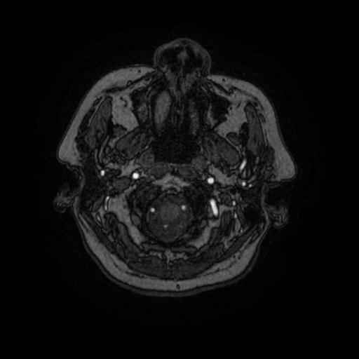 Cavernoma with developmental venous anomaly (Radiopaedia 22470-22507 MRA 102).jpg