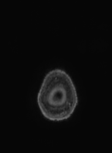 Cavernous hemangioma of the cerebellar falx (Radiopaedia 73025-83724 Axial T1 C+ 1).jpg