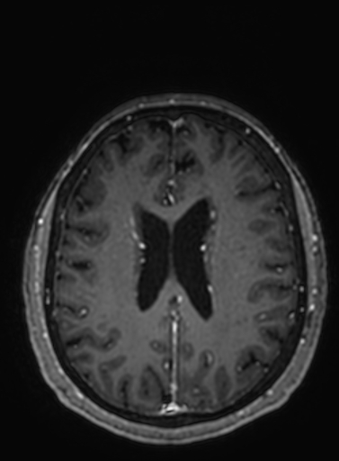 Cavernous hemangioma of the cerebellar falx (Radiopaedia 73025-83724 Axial T1 C+ 120).jpg