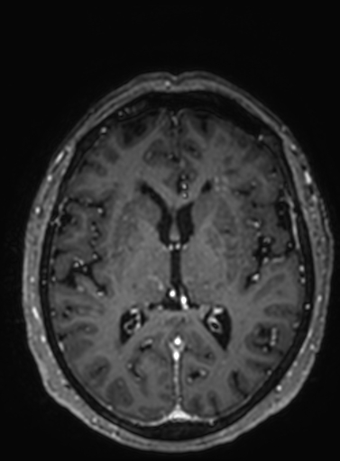 File:Cavernous hemangioma of the cerebellar falx (Radiopaedia 73025-83724 Axial T1 C+ 160).jpg