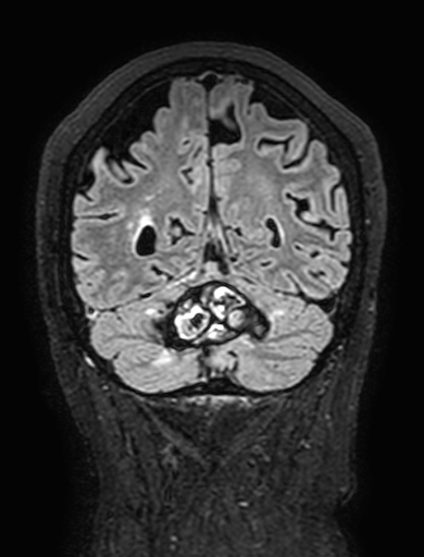 Cavernous hemangioma of the cerebellar falx (Radiopaedia 73025-83724 Coronal FLAIR 269).jpg