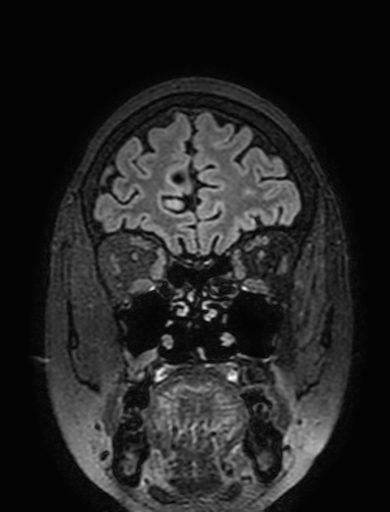 Cavernous hemangioma of the cerebellar falx (Radiopaedia 73025-83724 Coronal FLAIR 59).jpg
